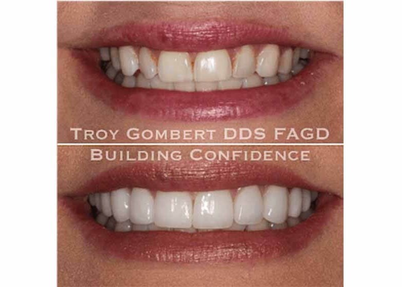 before and after veneers